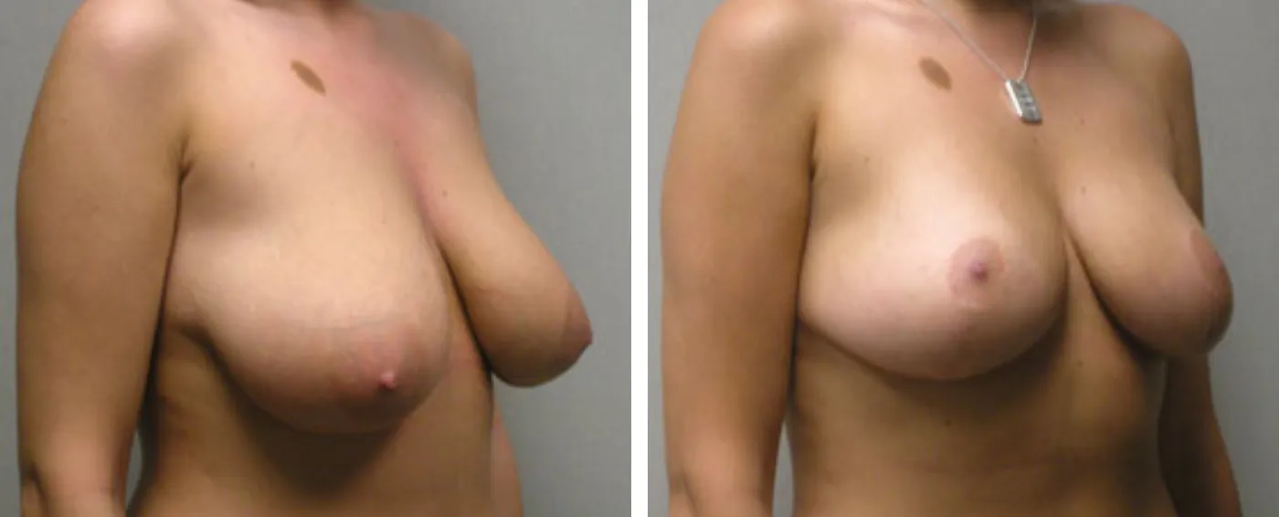 Breast lift b