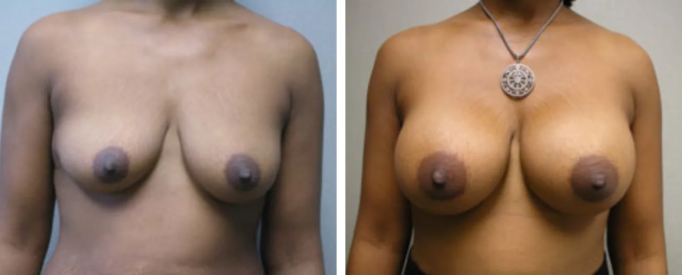 Breast Aug Periareolar lift a