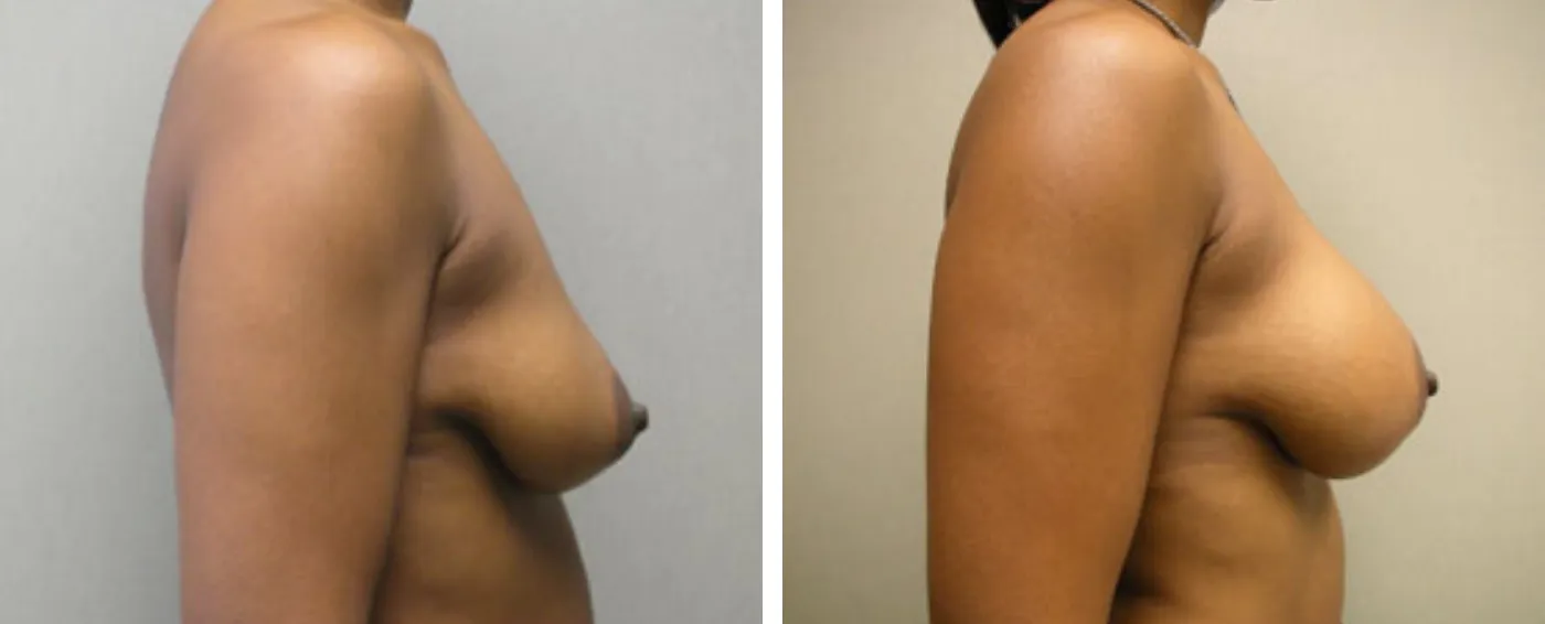 Breast Aug Periareolar lift c