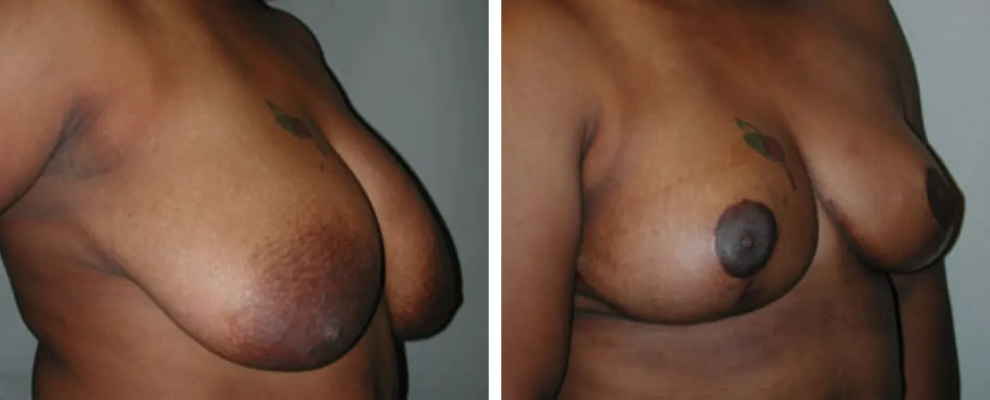 Breast lift b