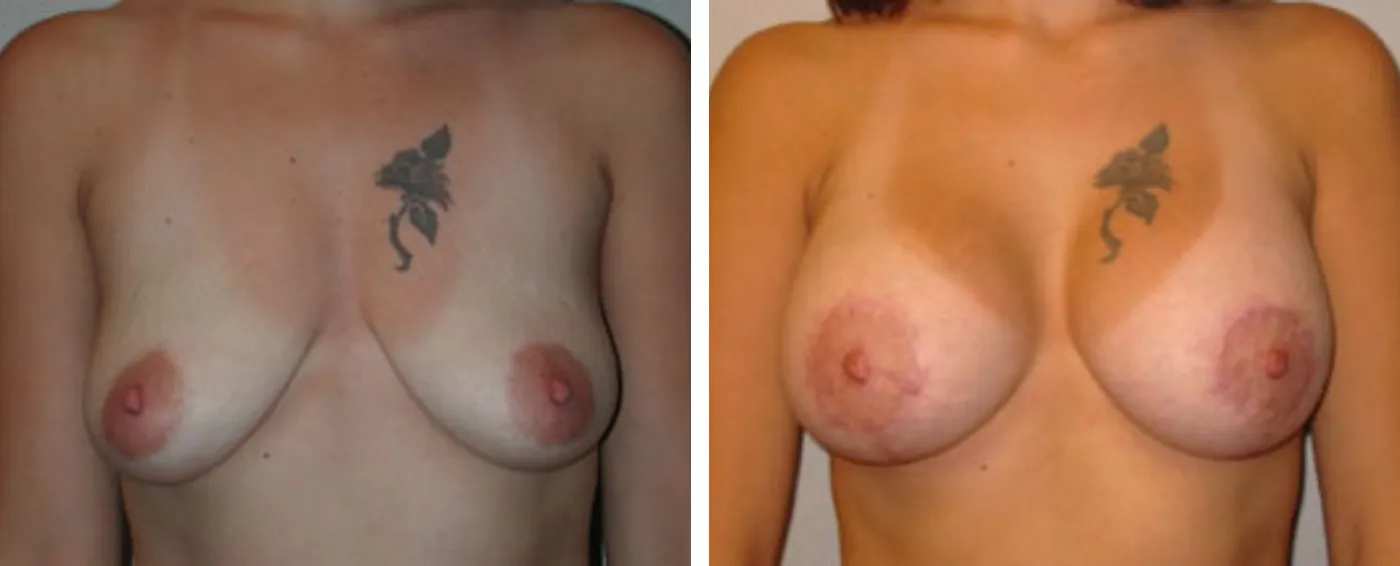 Breast Aug Periareolar lift a