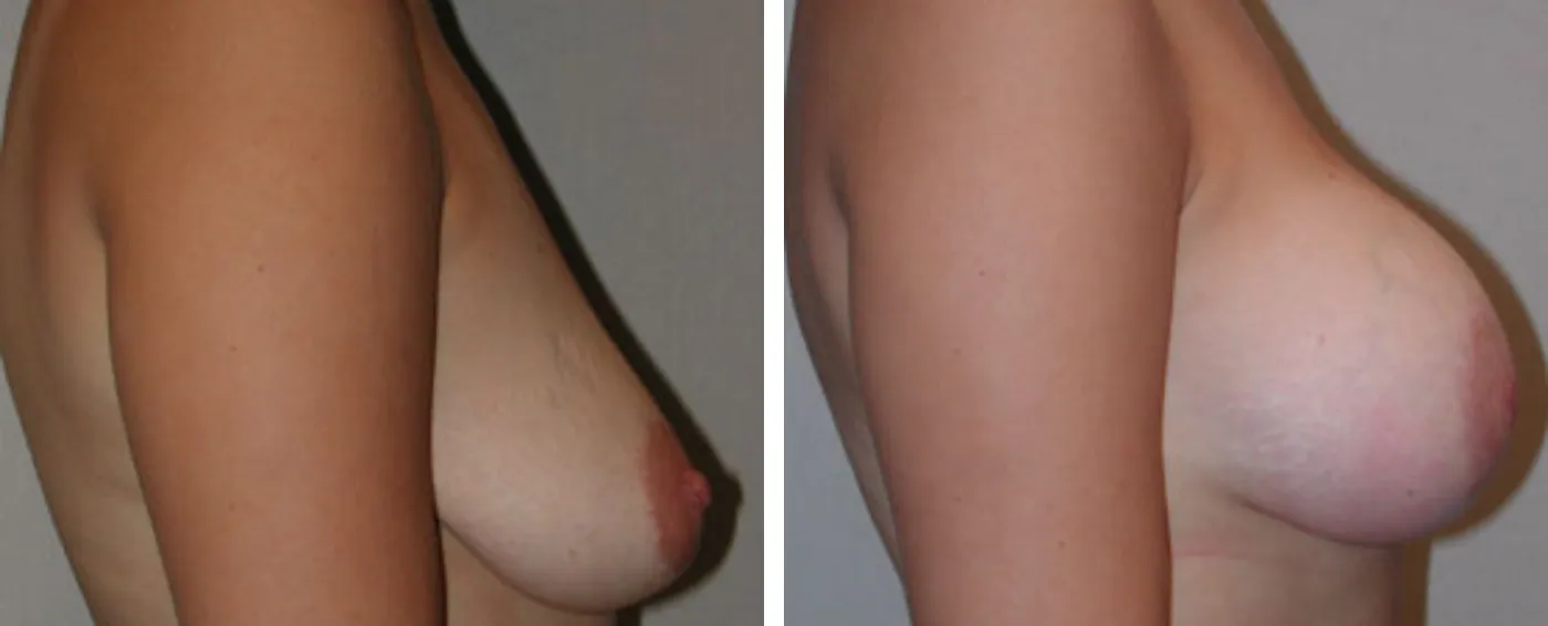 Breast Aug Periareolar lift c