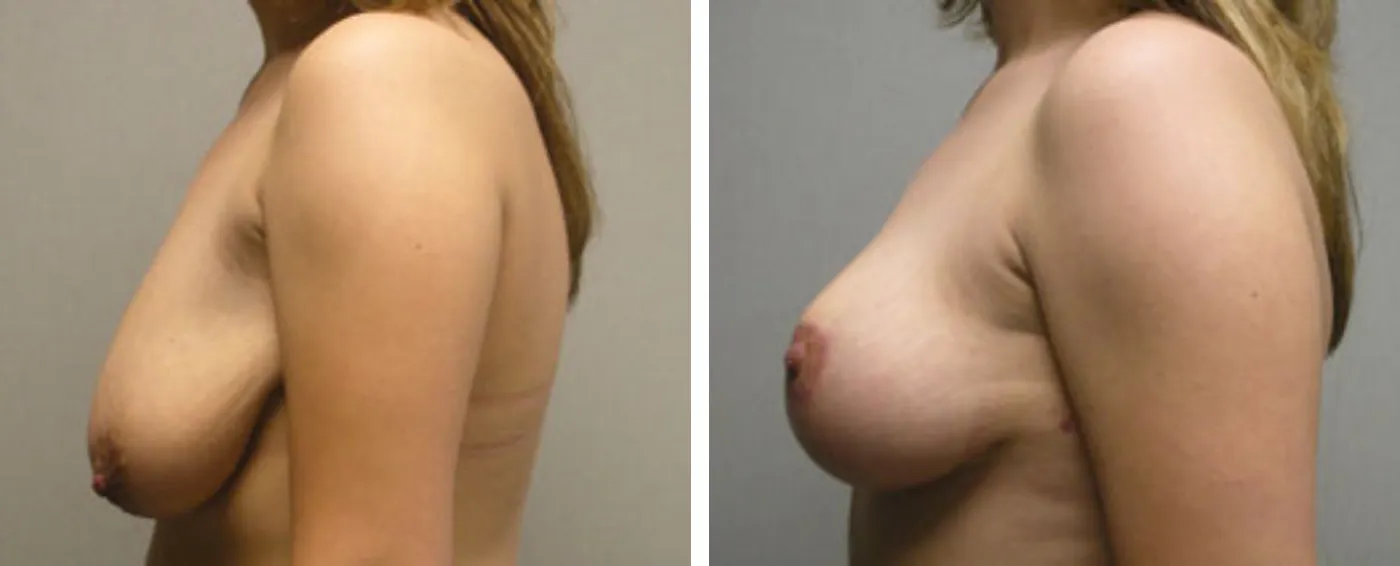 Breast lift c