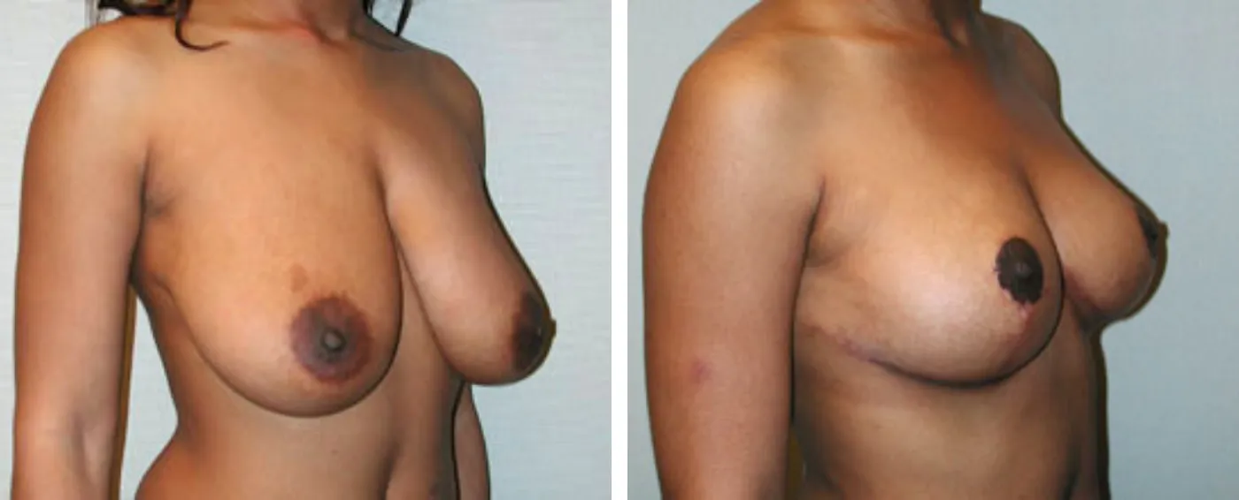 Breast Reduction C (Angle)