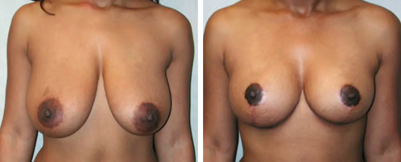 Breast Reduction C (front)