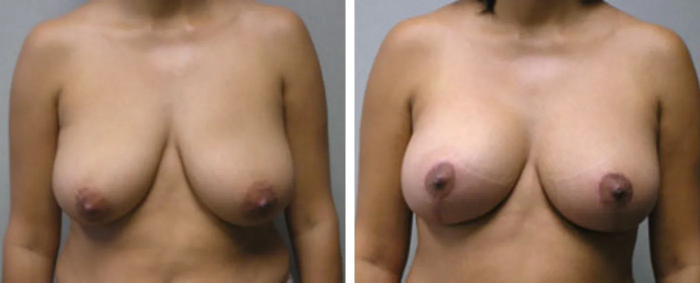 Breast lift a