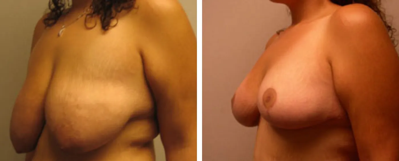 Breast lift b