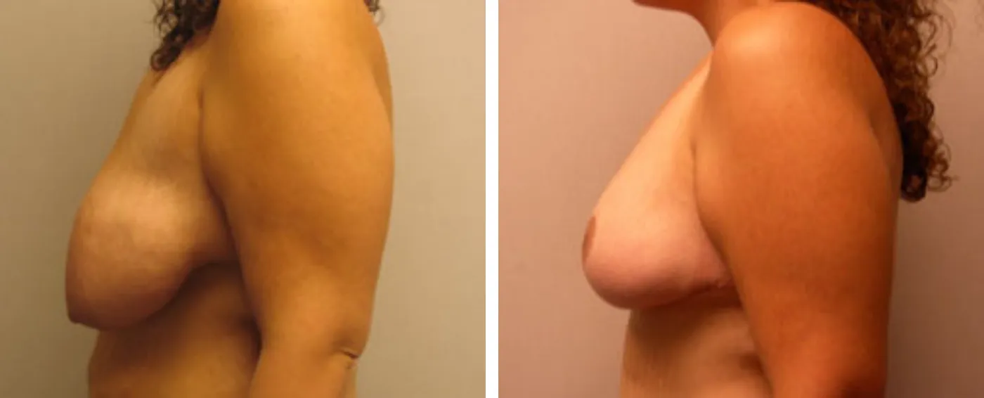 Breast lift c
