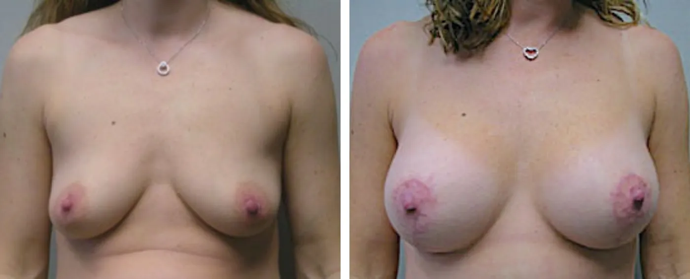 Breast Aug Periareolar lift a