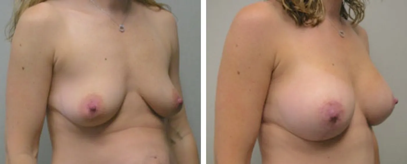 Breast Aug Periareolar lift b