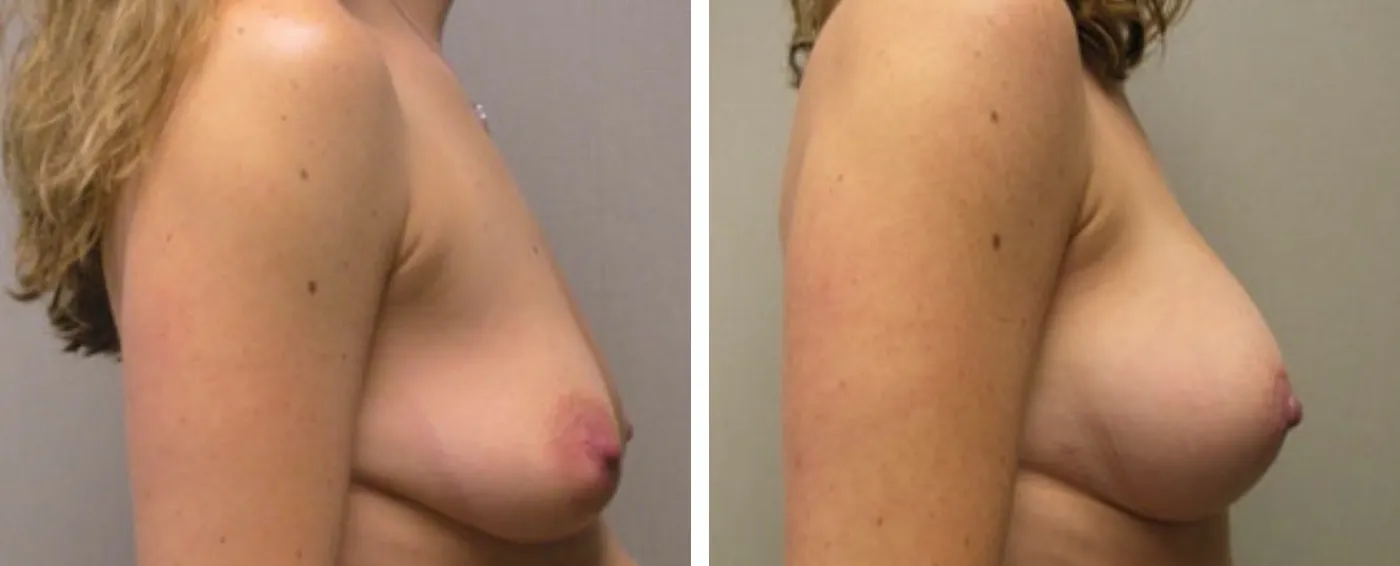 Breast Aug Periareolar lift c