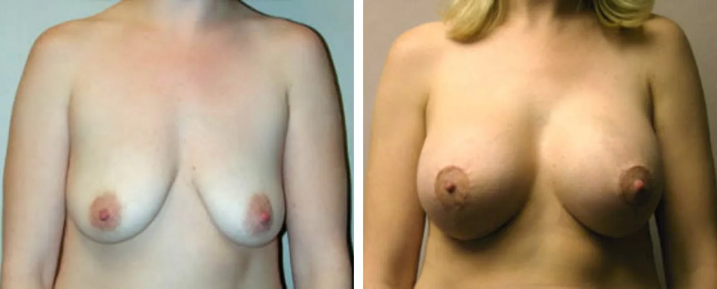Breast Augmentation with Lollipop Lift a