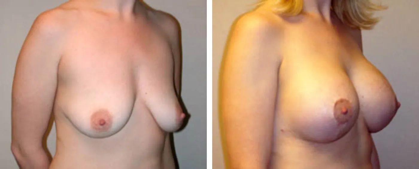 Breast Augmentation with Lollipop Lift b