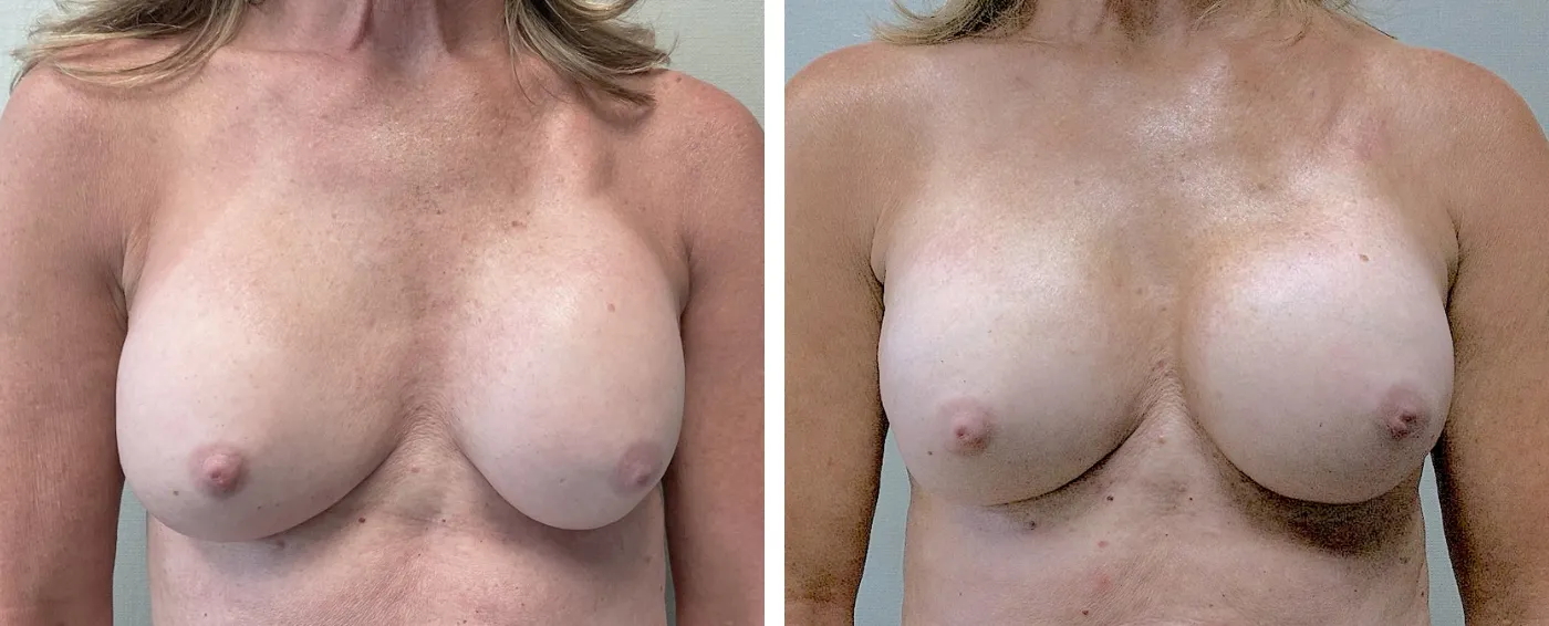 Breast Implant Removal and Replacement in Michigan a