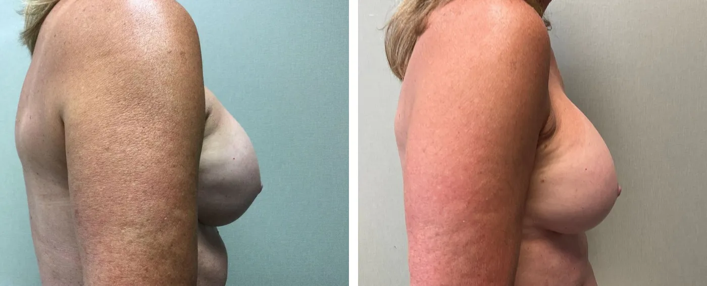 Breast Implant Removal and Replacement in Michigan c