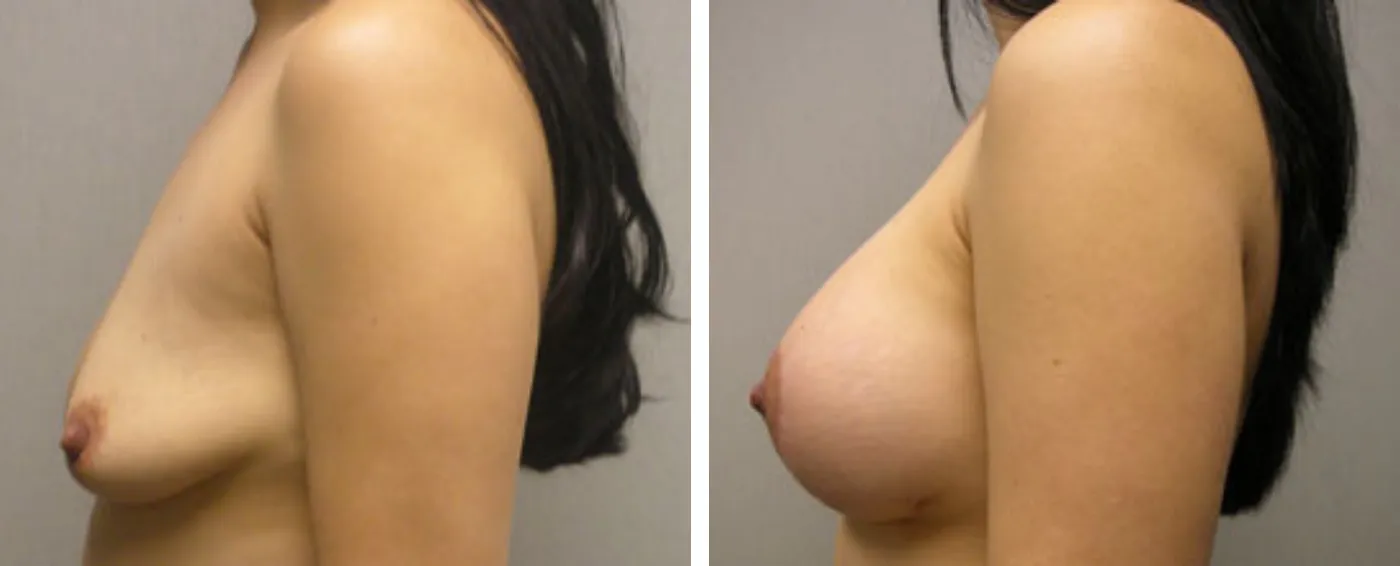 Breast Aug Periareolar lift c