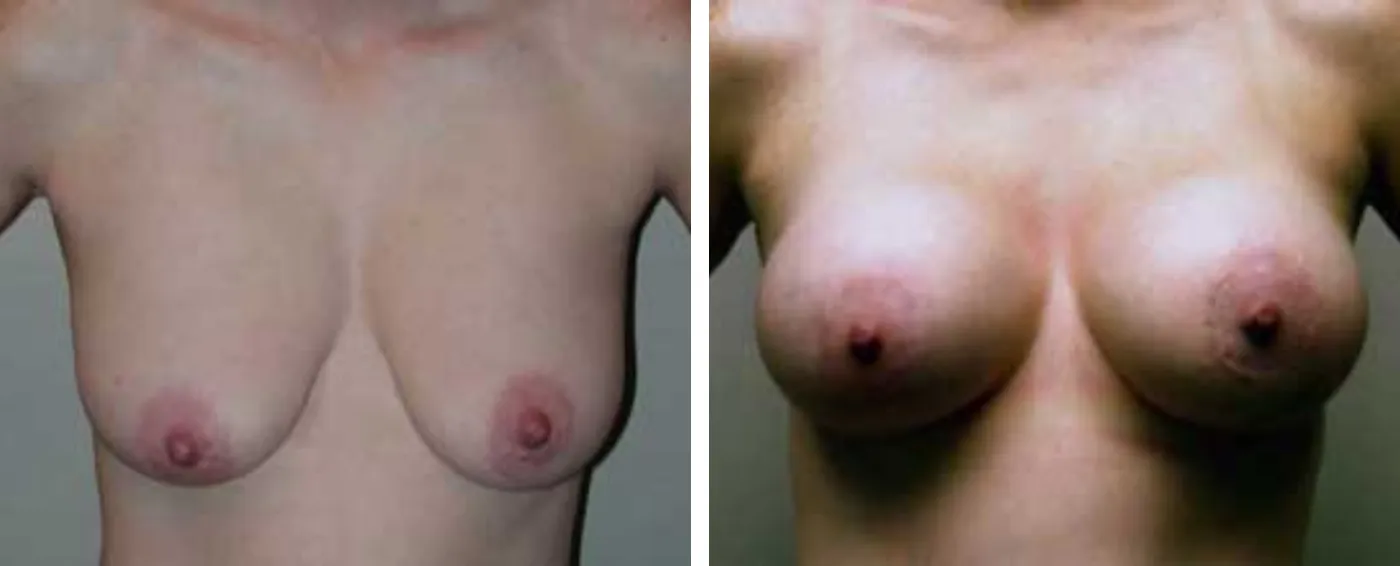Breast Augmentation with Lollipop Lift a