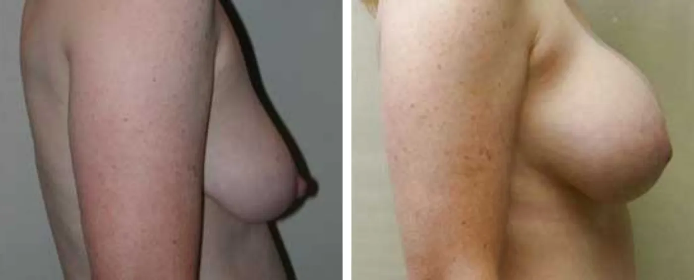Breast Augmentation with Lollipop Lift c