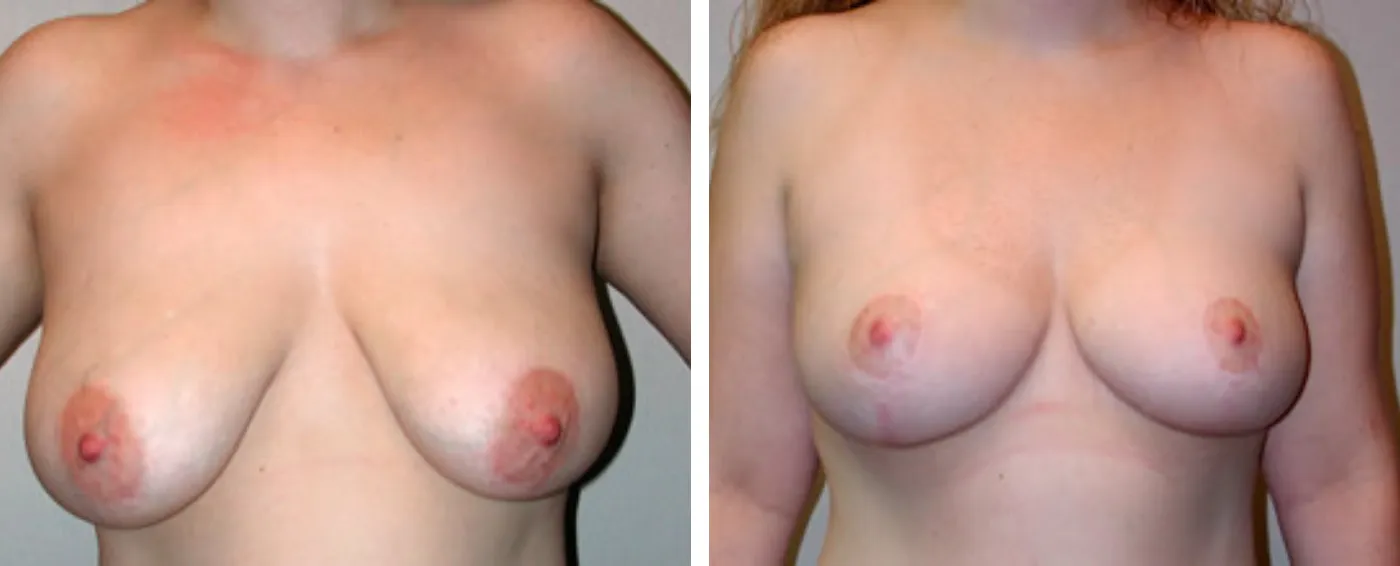 Breast lift a