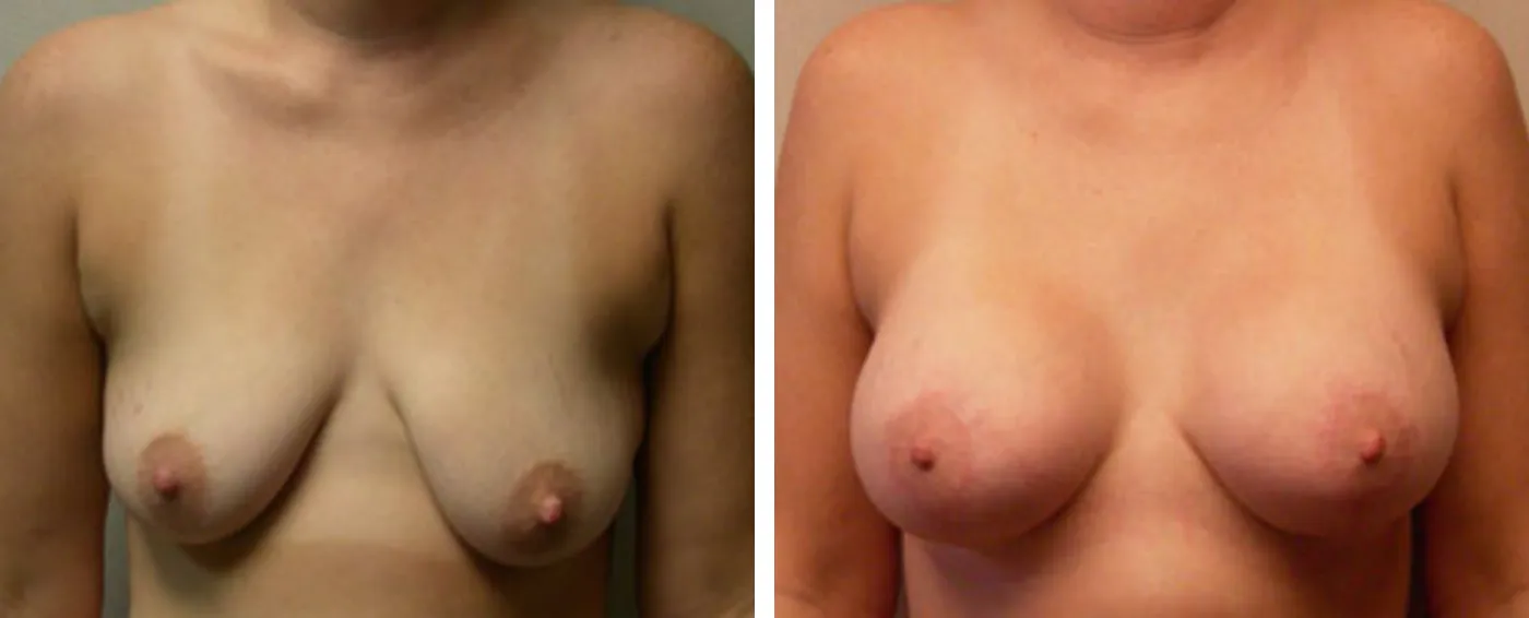 Breast Aug Periareolar lift a