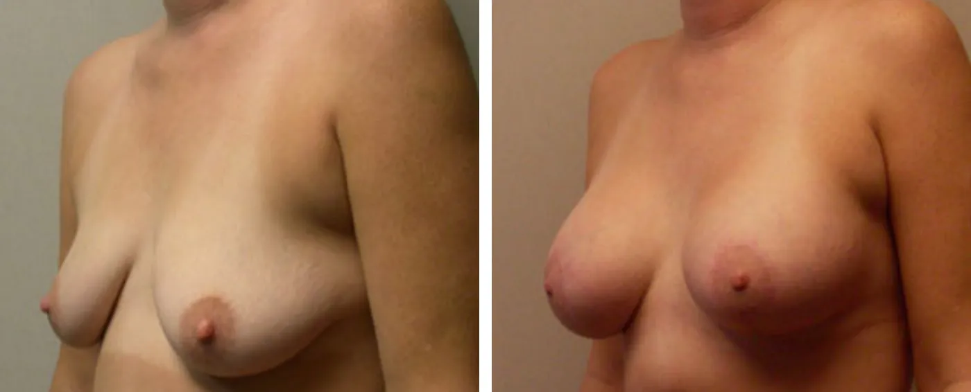 Breast Aug Periareolar lift b