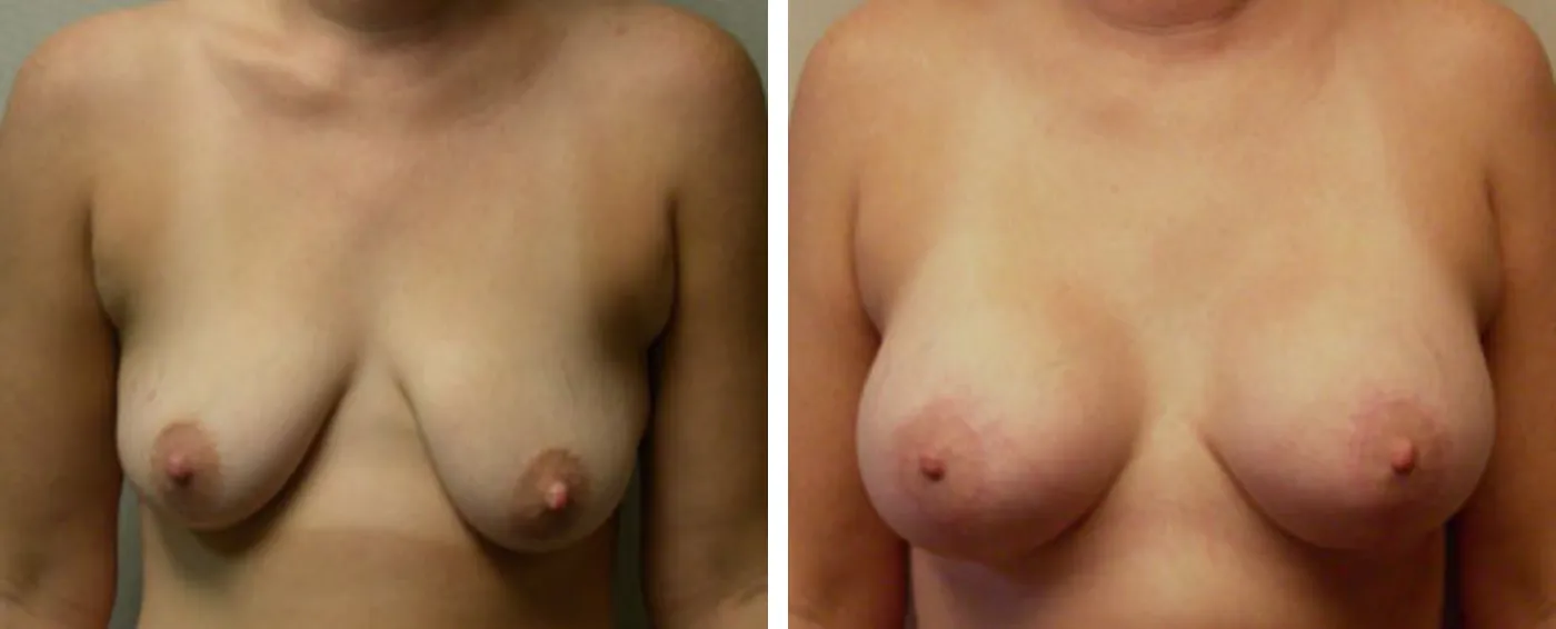 Breast Augmentation with Lollipop Lift a
