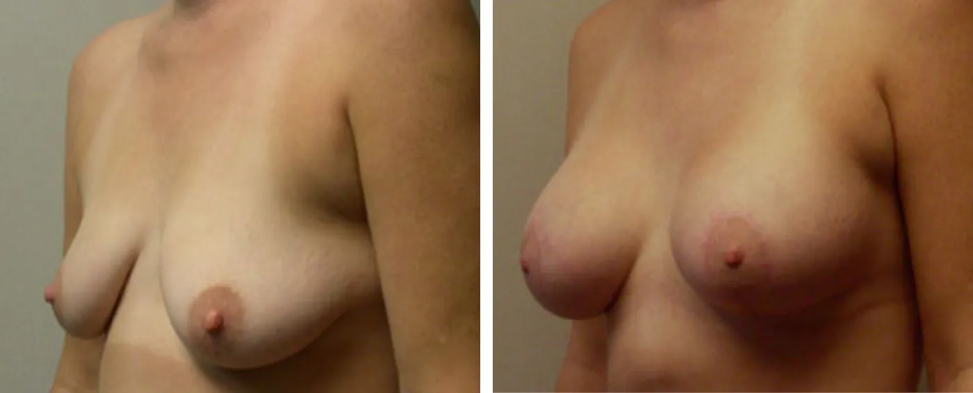 Breast Augmentation with Lollipop Lift b