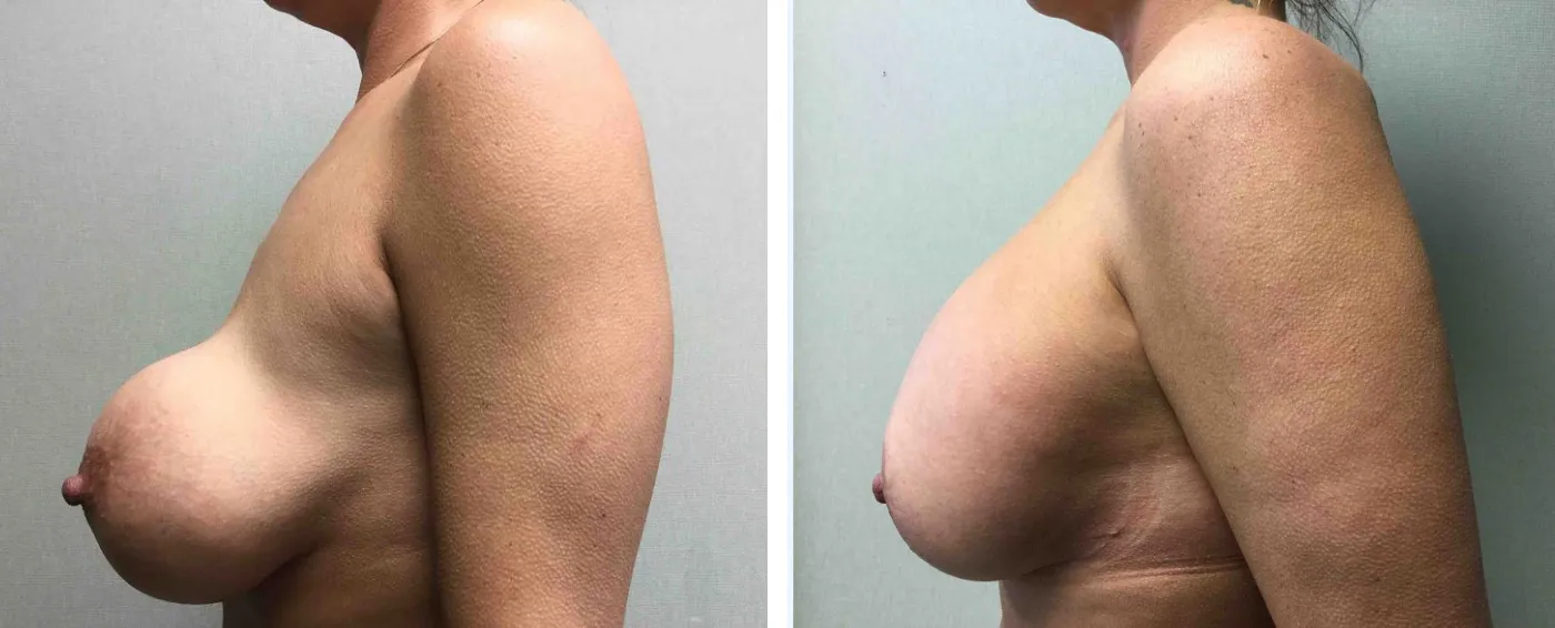 Breast Implant Removal and Replacement in Michigan b