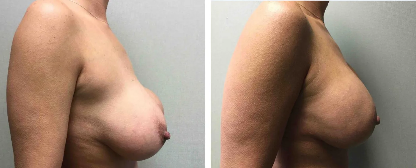 Breast Implant Removal and Replacement in Michigan c