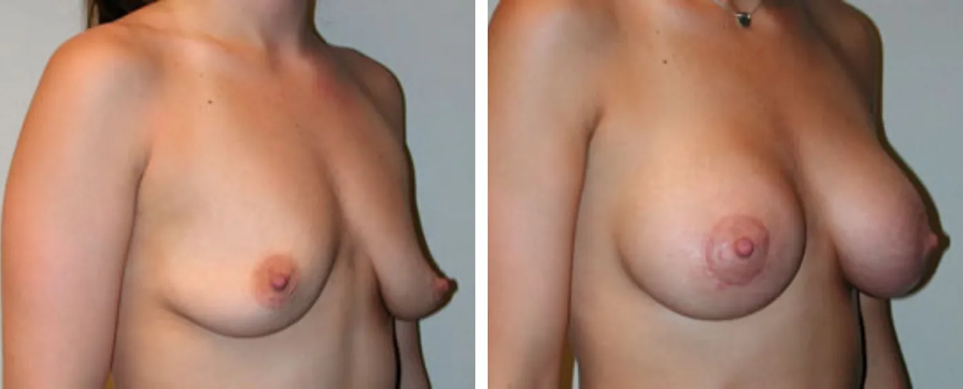 Breast Aug Periareolar lift b
