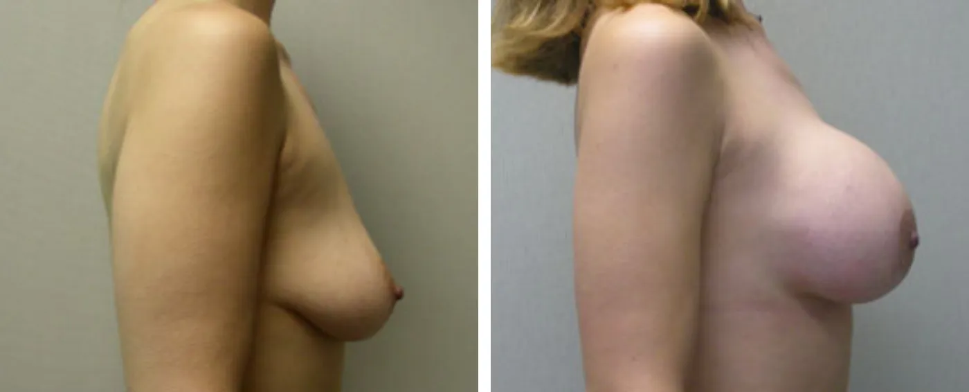 Breast Augmentation with Lollipop Lift c