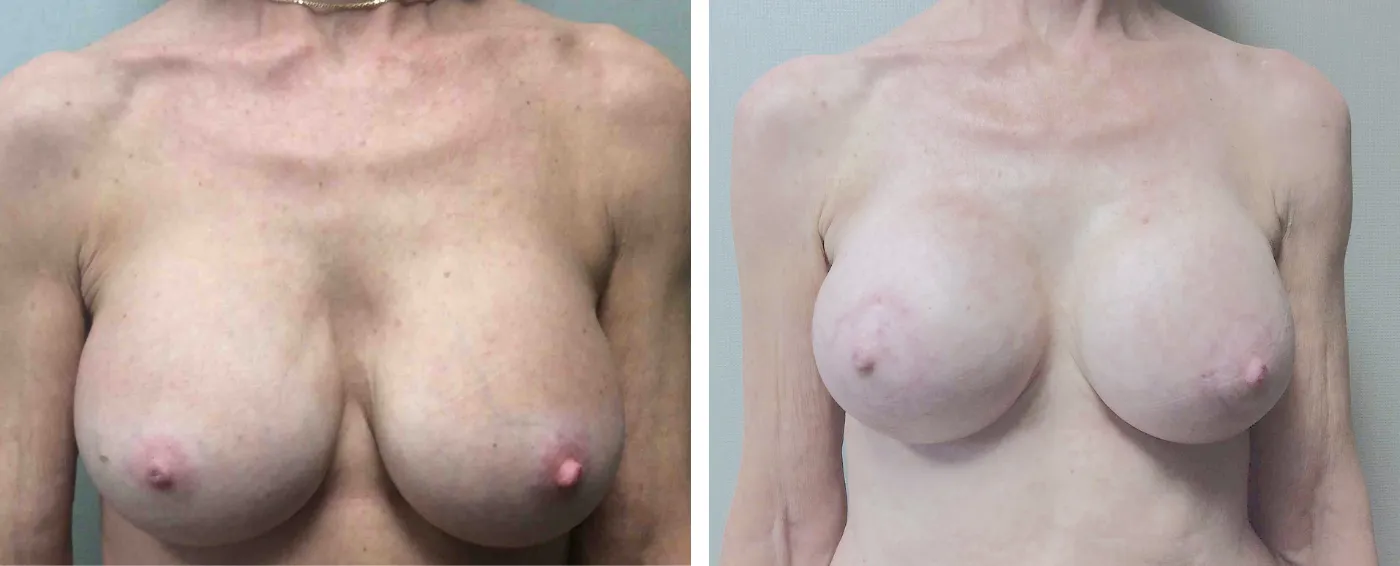 Breast Implant Removal and Replacement in Michigan a