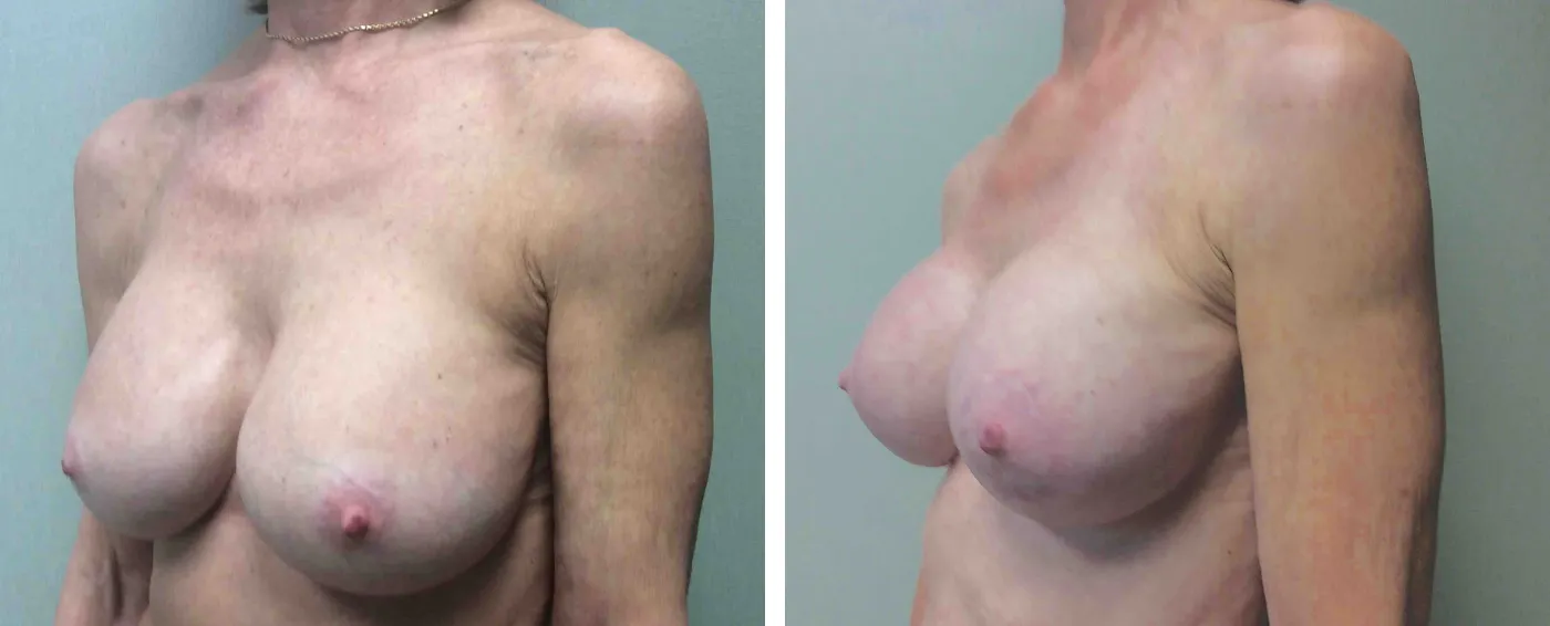 Breast Implant Removal and Replacement in Michigan b