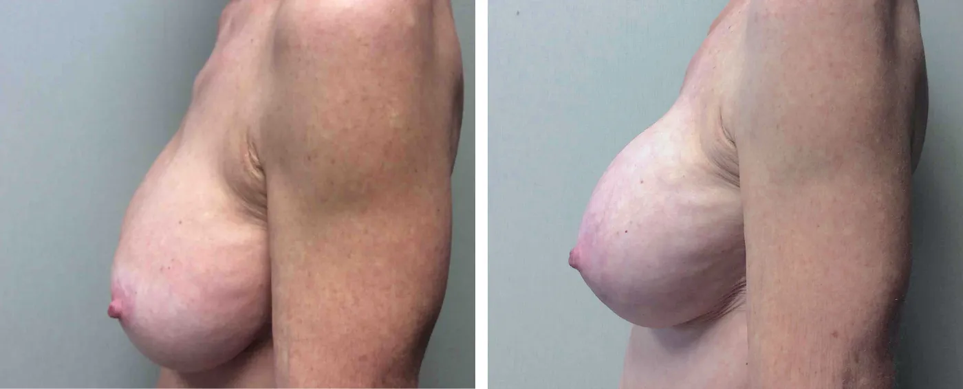 Breast Implant Removal and Replacement in Michigan c