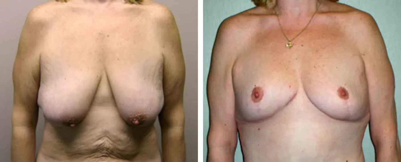 Breast lift a