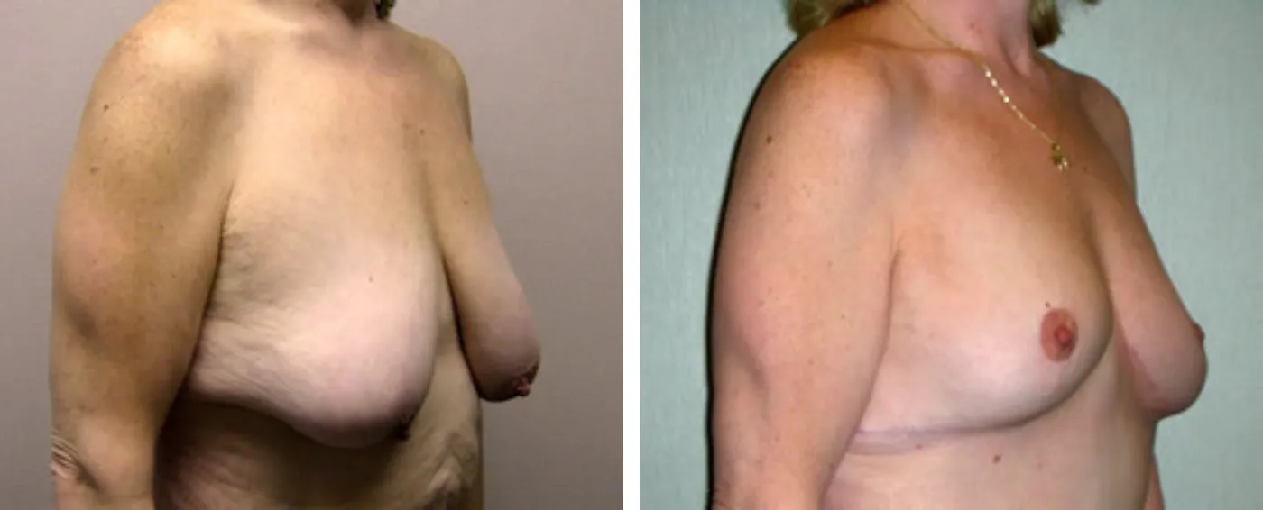 Breast lift b