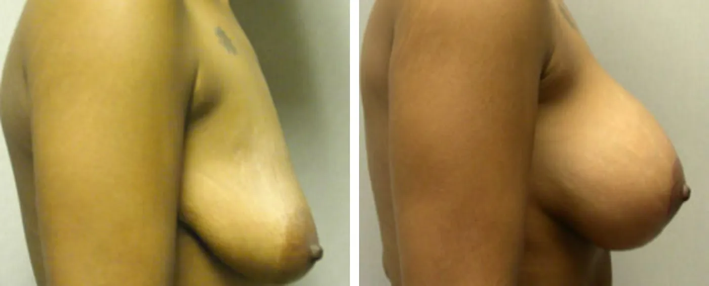 Breast Augmentation with Lollipop Lift c