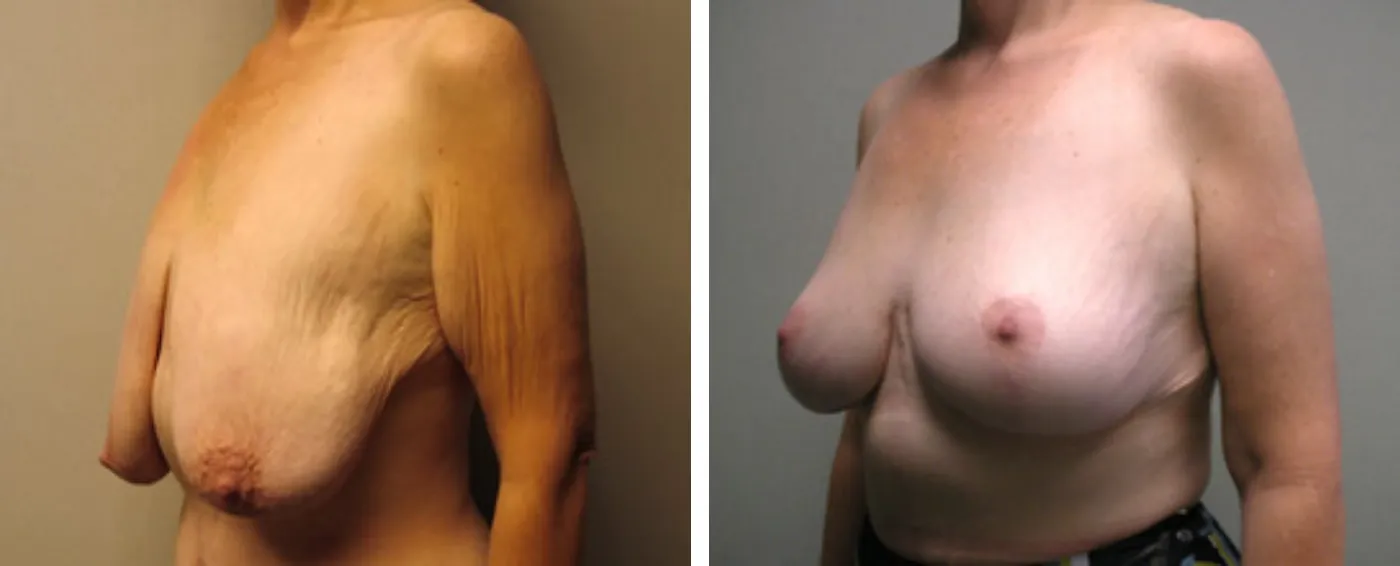 Breast lift b
