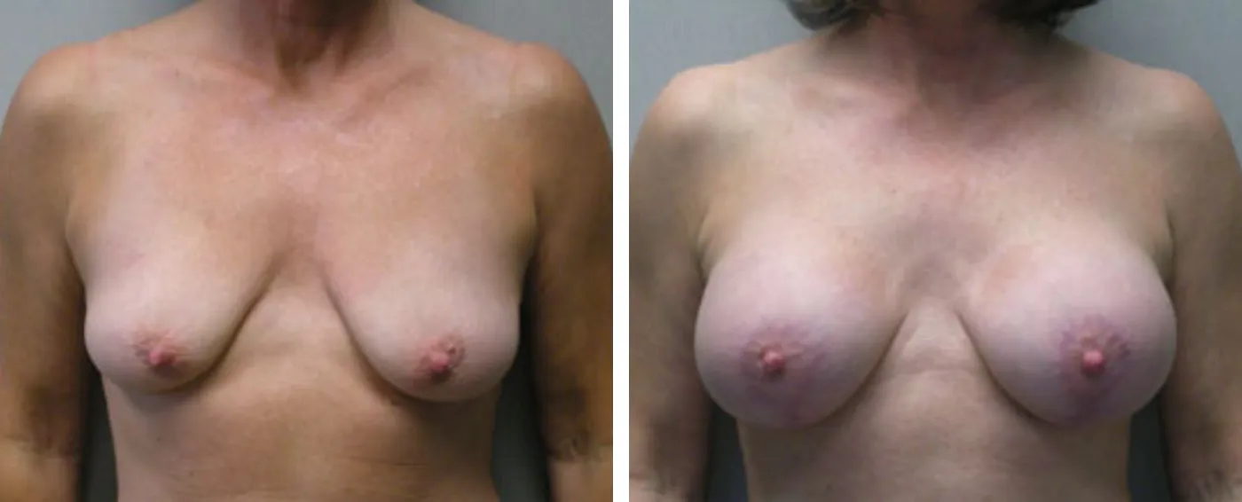 Breast Aug Periareolar lift a