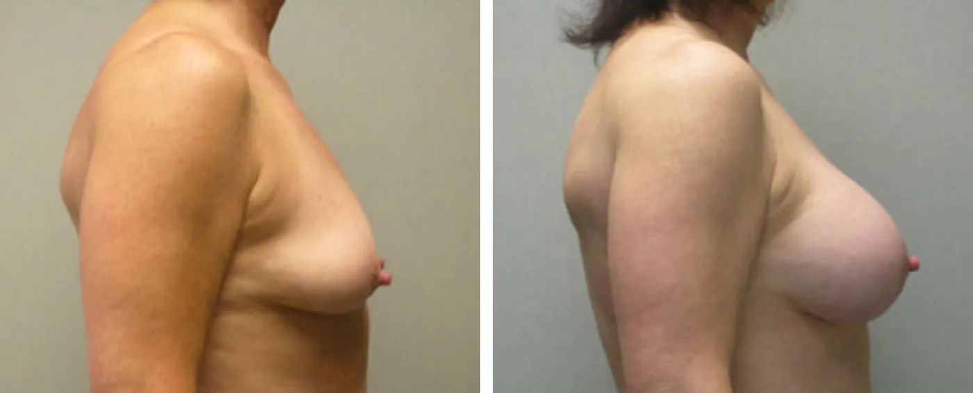 Breast Aug Periareolar lift c