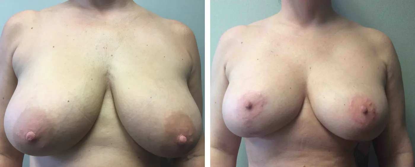 Breast Augmentation with Lollipop Lift a