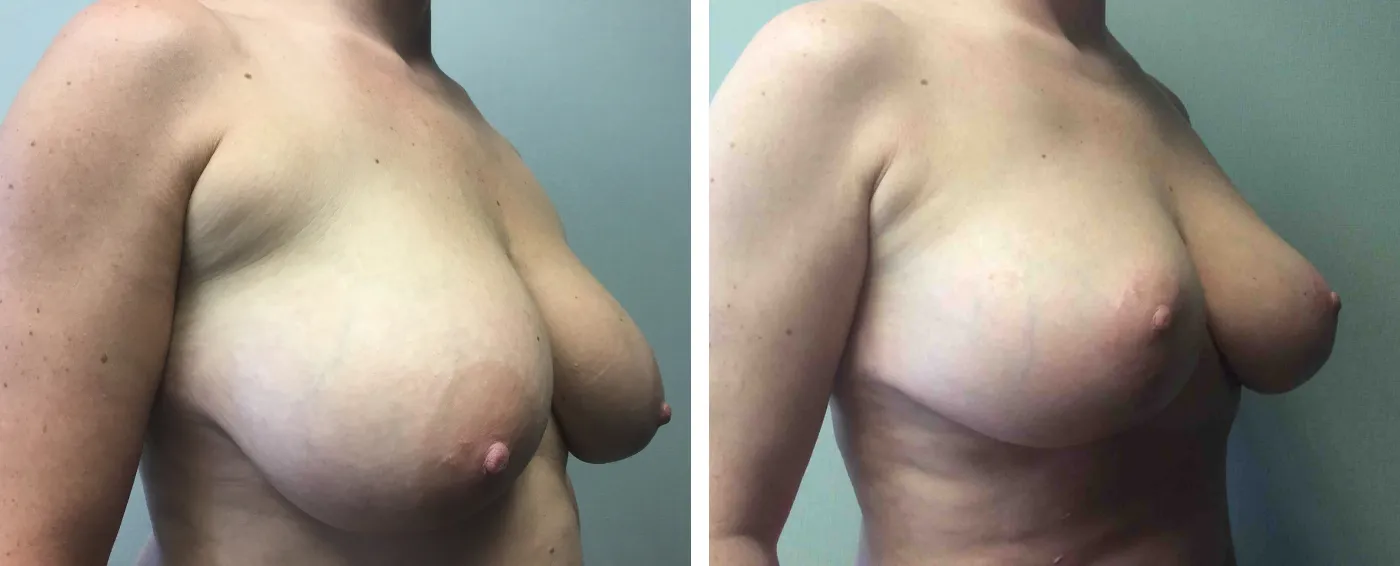 Breast Augmentation with Lollipop Lift b