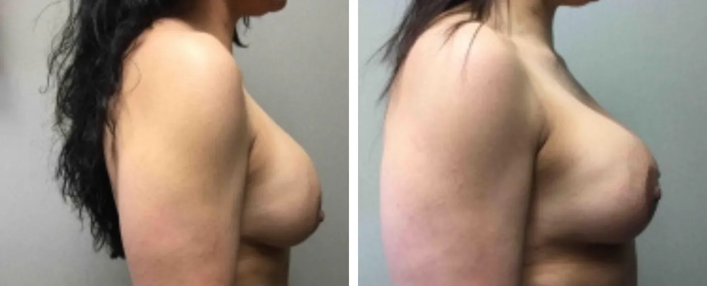 Breast Implant Removal and Replacement in Michigan c