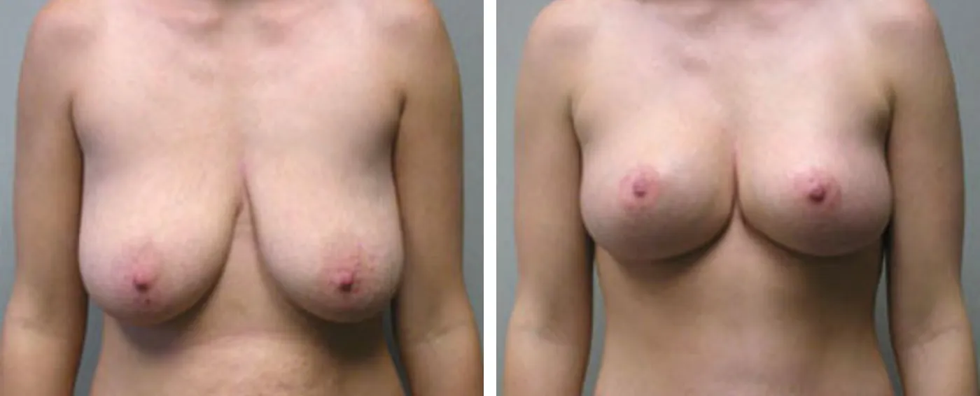 Breast lift A