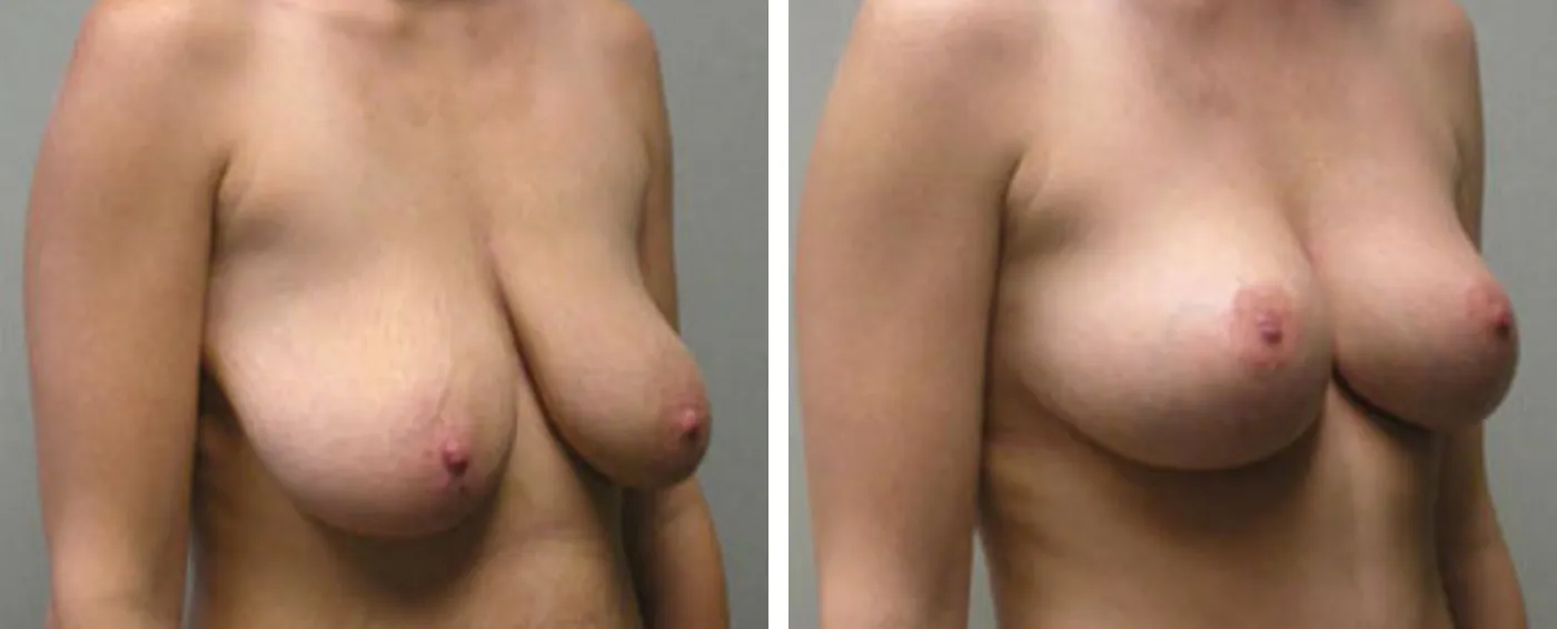 Breast lift B