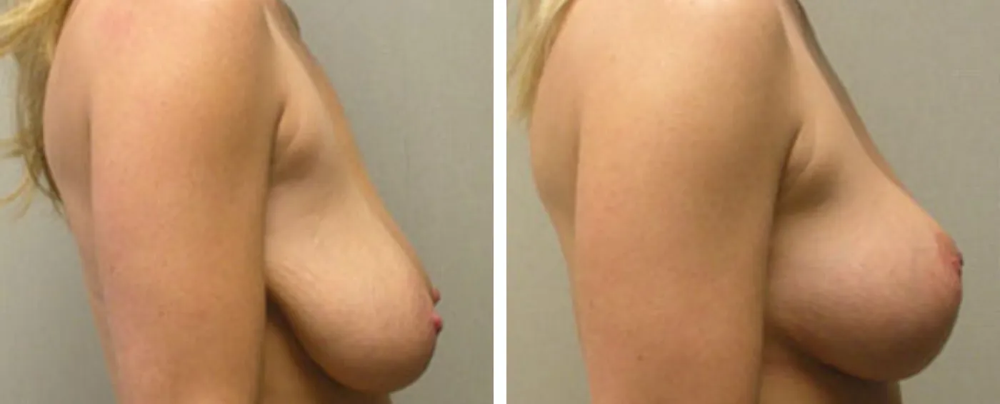 Breast lift C