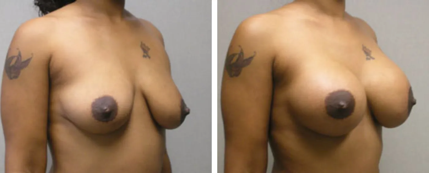 Breast Aug Periareolar lift a ()