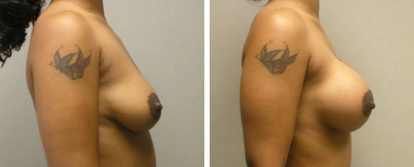 Breast Aug Periareolar lift a ()