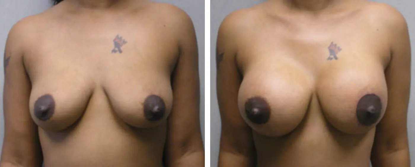 Breast Aug Periareolar lift a