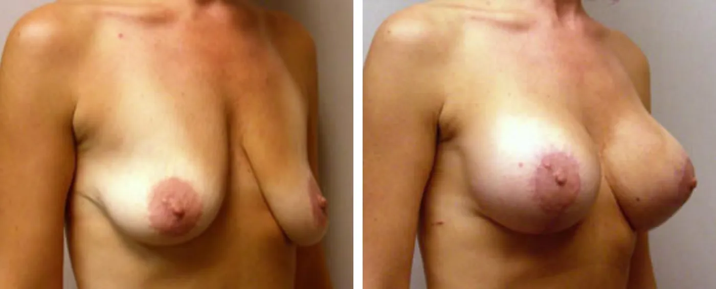 Breast Augmentation with Lollipop Lift b